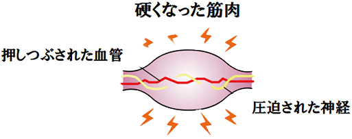 硬くなった筋肉